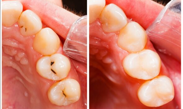 white-tooth-filling white-tooth-filling